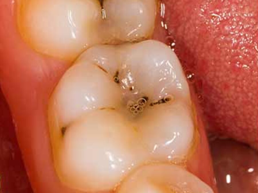 Caries y resinas — Antes
