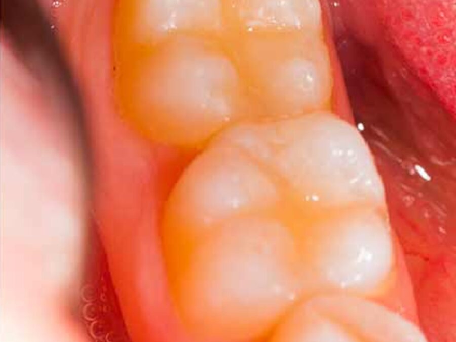 Caries y resinas
