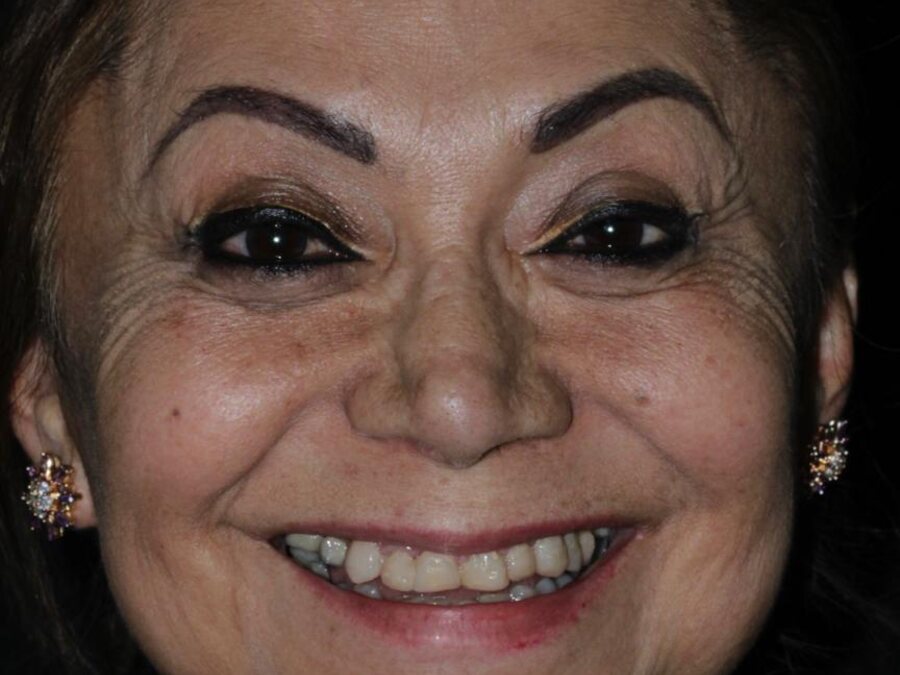Diseño de sonrisa, caso real de SANI — Antes