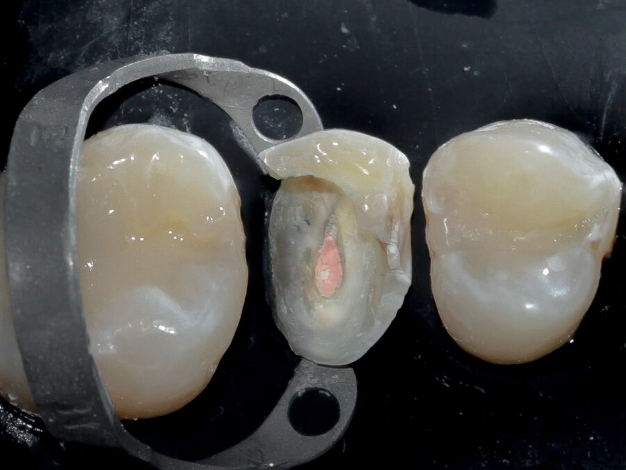 Endodoncia — Antes