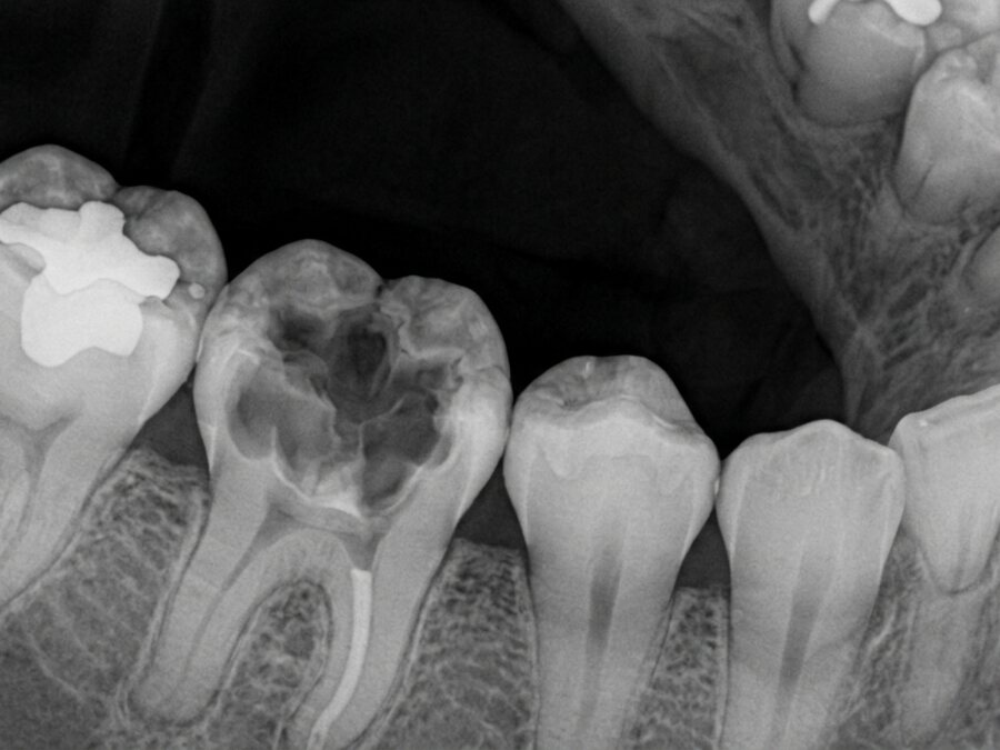 Endodoncia: Radiografía de control