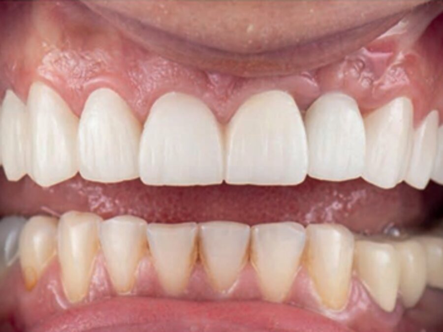 Implantes dentales