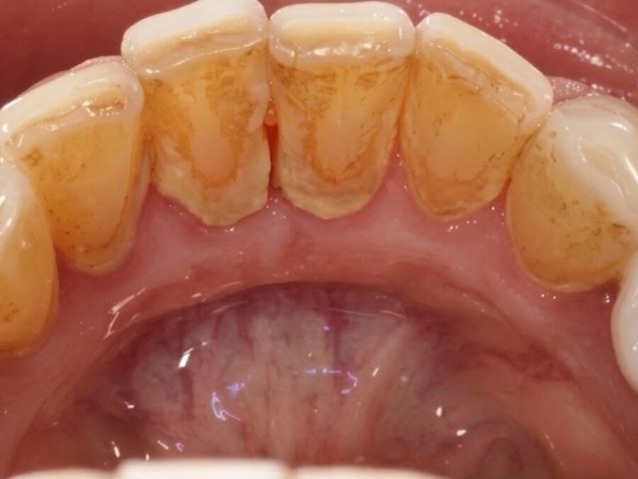 Limpieza dental — Antes